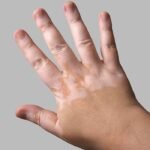 Cure for vitiligo in Australia