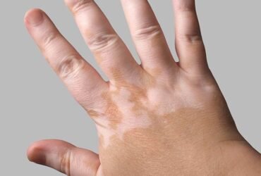 Cure for vitiligo in Australia